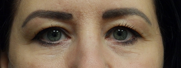Blepharoplasty (Eyelid Surgery)