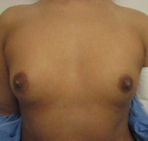 Breast Augmentation
