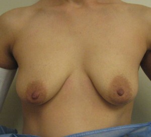 Breast Augmentation