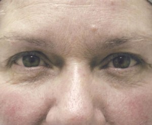 Blepharoplasty (Eyelid Surgery)