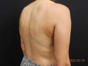 Liposuction