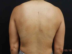 Liposuction