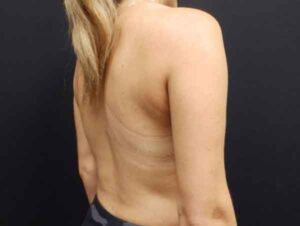 Liposuction