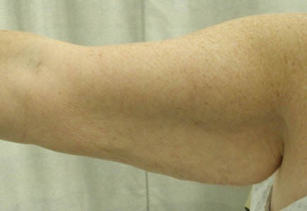 Brachioplasty (Arm Lift)