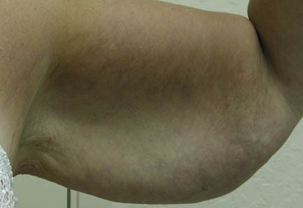 Brachioplasty (Arm Lift)