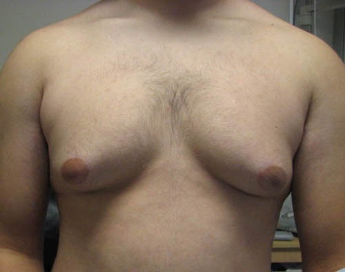 Gynecomastia (Male Breast Reduction)
