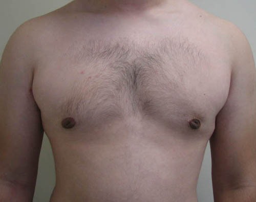 Gynecomastia (Male Breast Reduction)