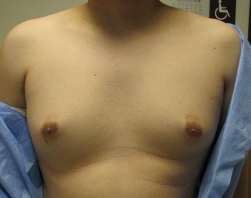 Gynecomastia (Male Breast Reduction)