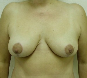 Breast Reduction