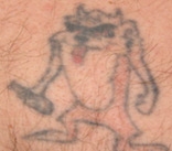 Laser Tattoo Removal